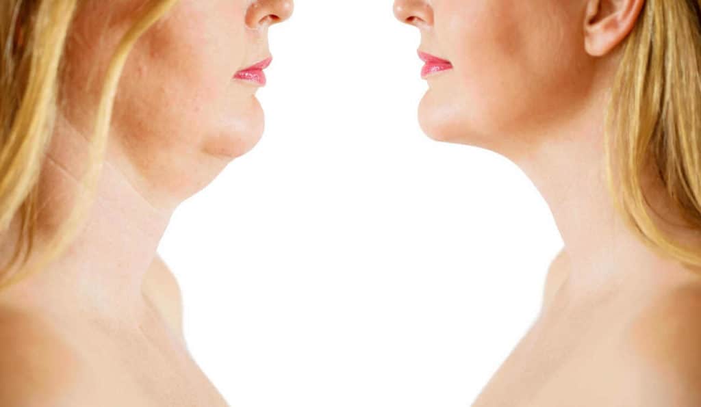 Double Chin treatment Kensal Town before and after results