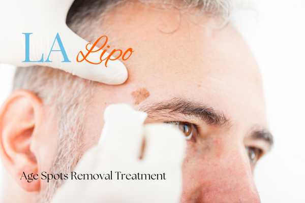 What Are the Most Effective Treatments for Age Spots Kensal Town?