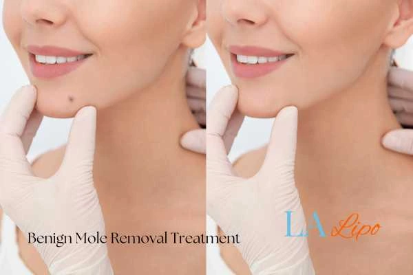 woman's before and after mole removal Kensal Town results