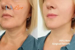 hi-fu for wrinkles Kensal Town before and after results