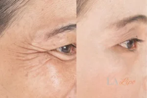 Before and after results of woman - HI-fu wrinkles reduction treatment Kensal Town