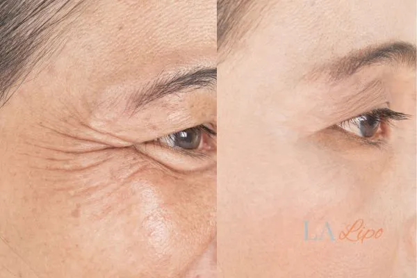 Before and after results of woman - HI-fu wrinkles reduction treatment Kensal Town
