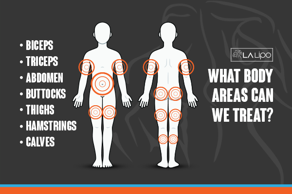 Graphic to show areas you can have LA-EMS Body Sculpting Kensal Town treatment.
