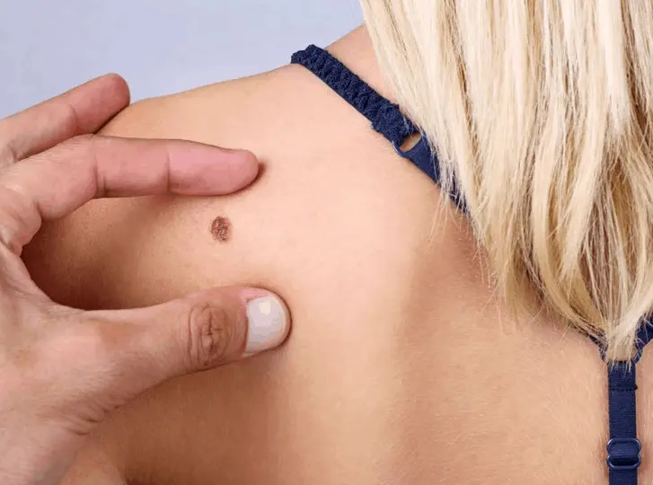 woman having mole removal Kensal Town consultation before treatment.
