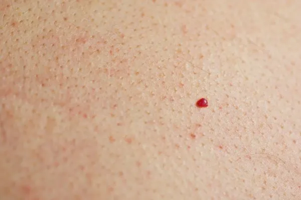 close up of a cherry angioma Kensal Town