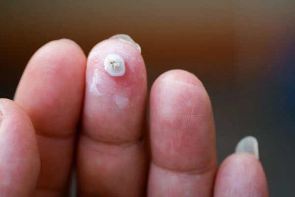wart on person finger - cryotherapy to treat from LA LIPO Kensal Town