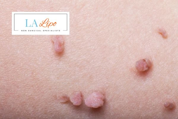 Does cryopen skin tag removal Kensal Town hurt? Find out now call our team today!
