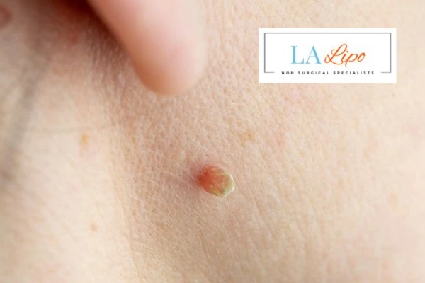 Book skin tag removal Kensal Town today speak to our team now!