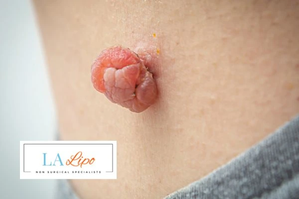 Interested in skin tag removal Kensal Town? Concerned about the pain? Find out more today!