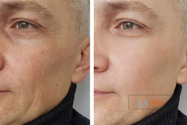 See the amazing results of Morpheus8 Treatment Kensal Town!