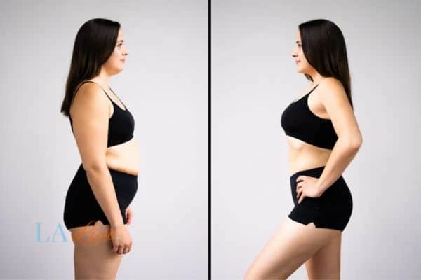 Picture of womans before and after using LA-EMS body sculpting to improve her core strength Kensal Town
