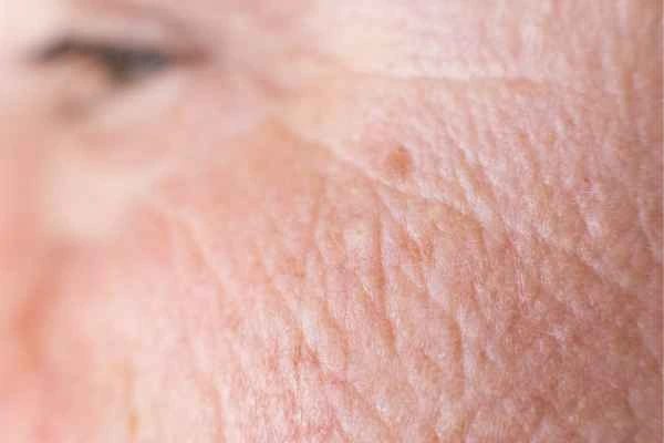 close up picture of a woman's face showing an age spot Kensal Town