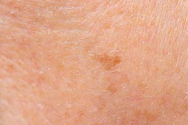 close up picture of age spots Kensal Town