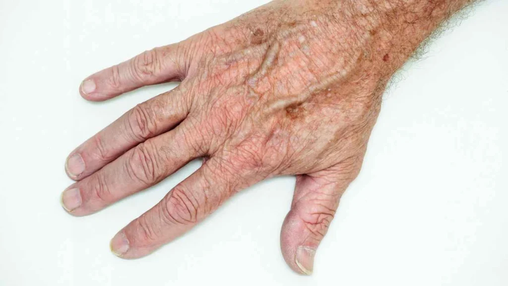 Male hand showing age spot Kensal Town