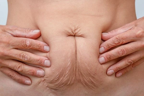 Image of a woman's stomach with loose skin - example of skin tightening Kensal Town options