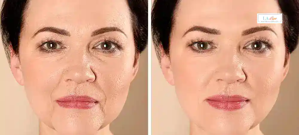 How Long Does It Take to See Results and How Long Do They Last Kensal Town?