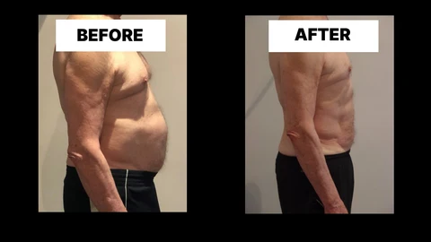 What Symptoms Can Diastasis Recti Cause in Men? Weak Core, Back Pain and Poor Posture Kensal Town